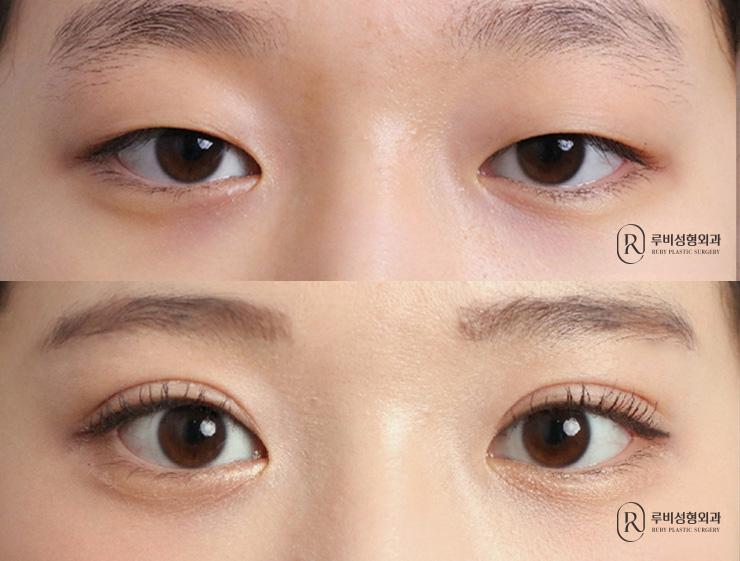 Natural adhesion, ptosis correction