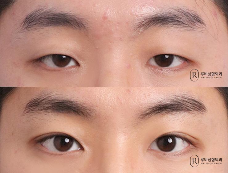 Men's natural adhesion, ptosis correction