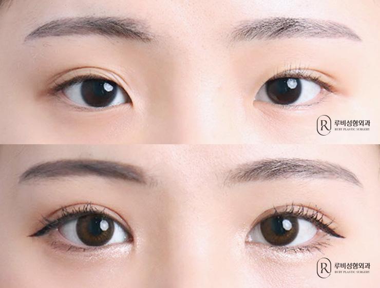 Natural adhesion, ptosis correction, epicanthoplasty