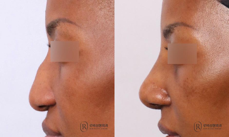 Nose bridge, nose tip, humpectomy, long nose correction