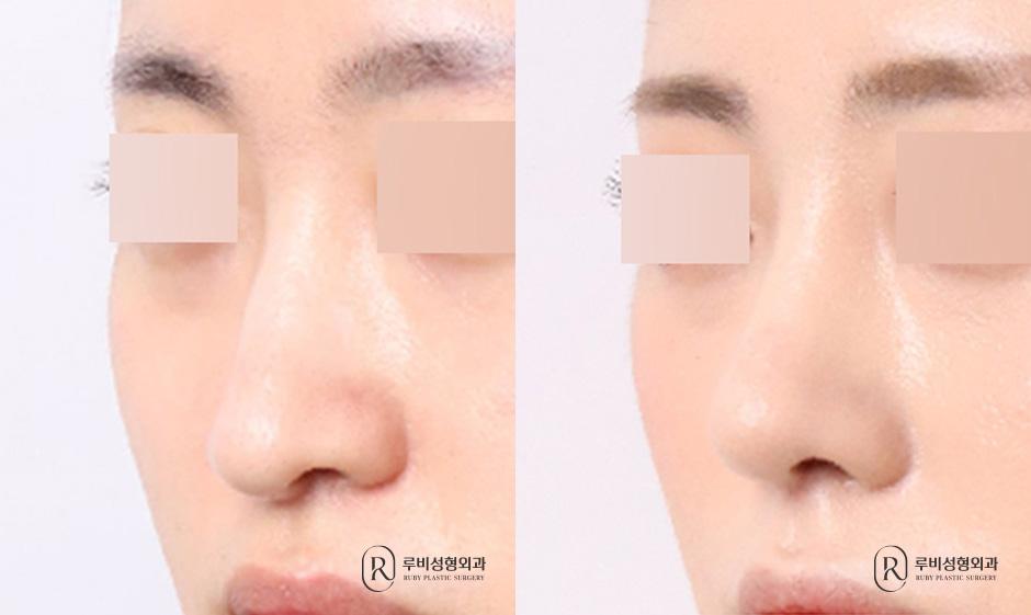 Nasal bridge, nasal tip, long nose correction