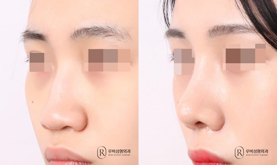 Nose bridge, nose tip, humpectomy, long nose correction