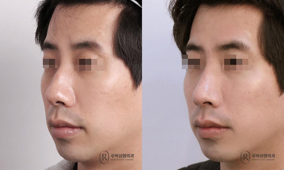 Nose bridge, nose tip, humpectomy