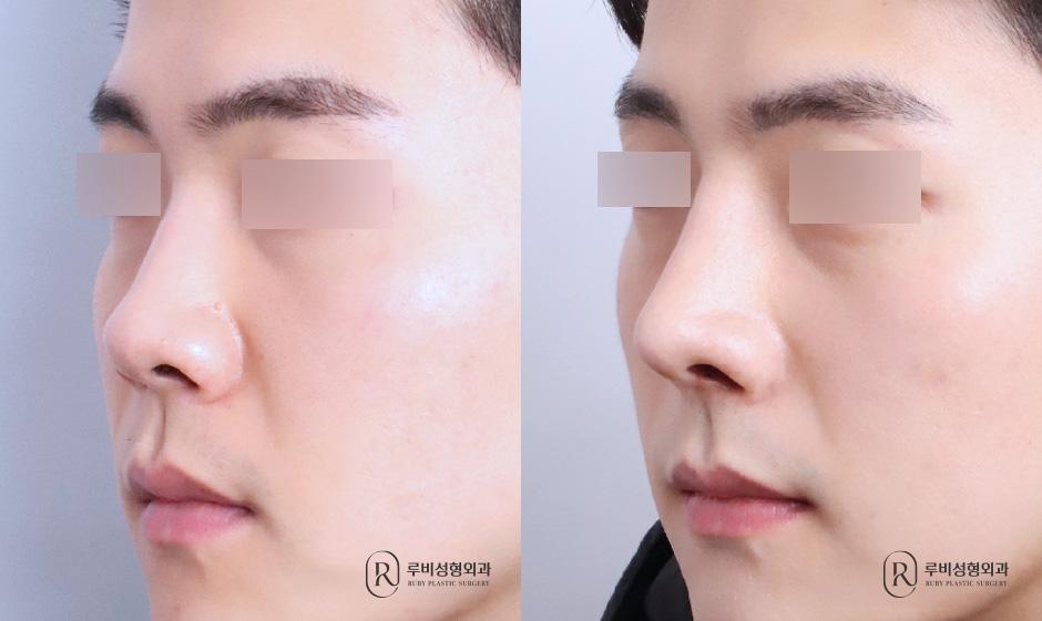 Nose bridge, nose tip, humpectomy, short nose correction, alar cinching