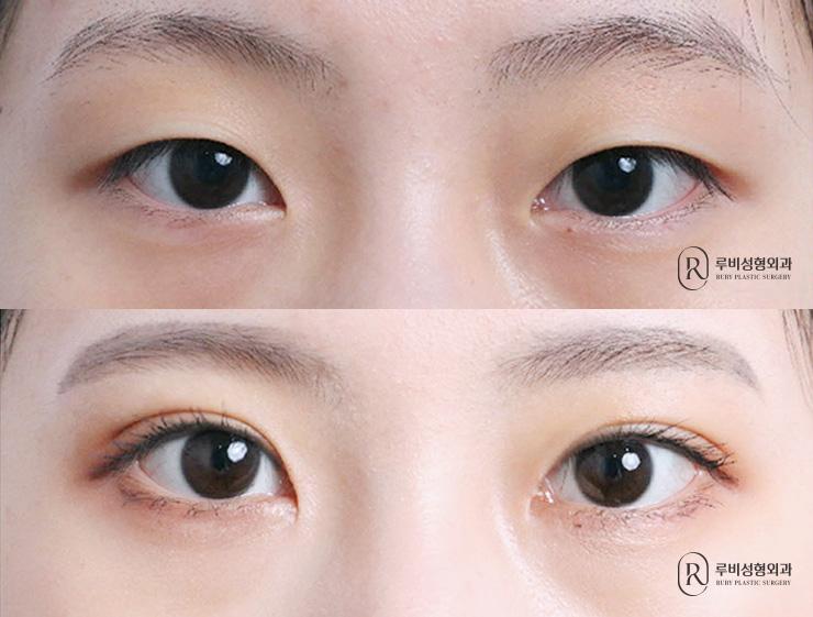 Natural adhesion, ptosis correction, epicanthoplasty