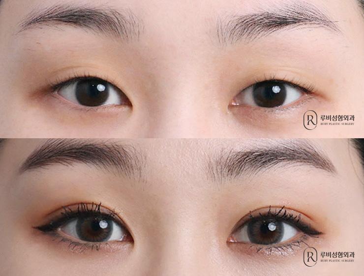 Natural adhesion, ptosis correction