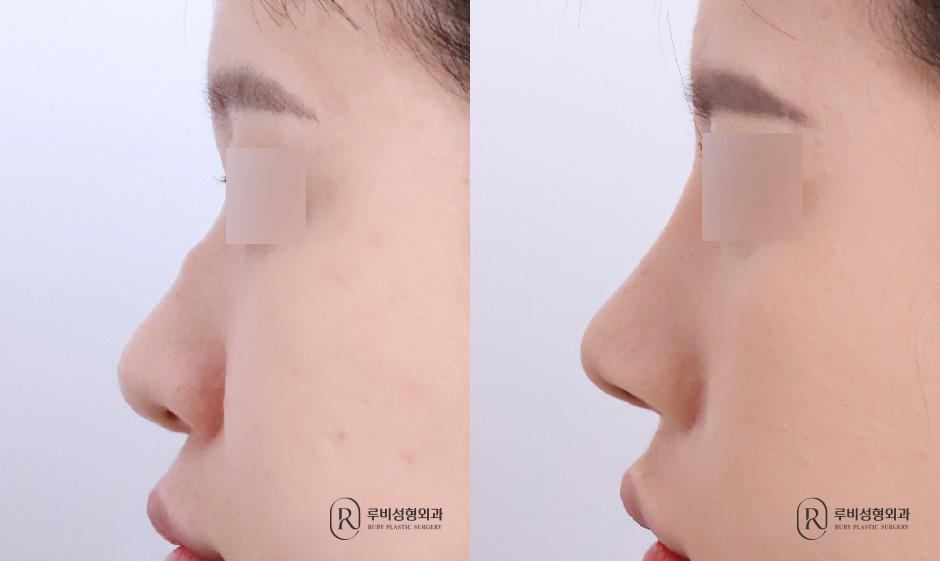 Nose bridge, nose tip, humpectomy, alar cinching