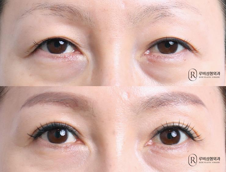 Brow lift, natural adhesion, ptosis correction