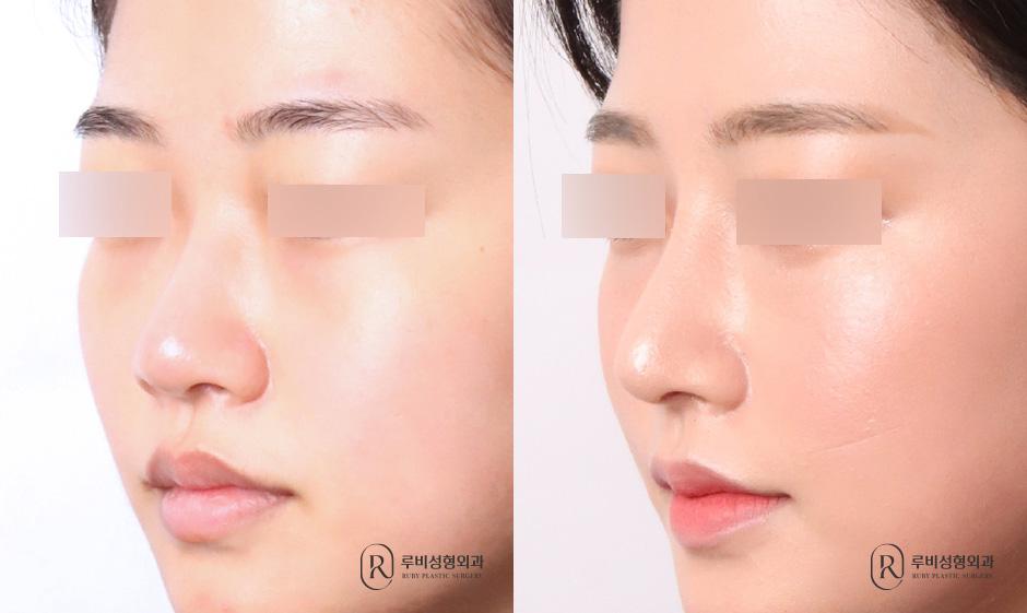Nose bridge, nose tip, humpectomy, short nose correction