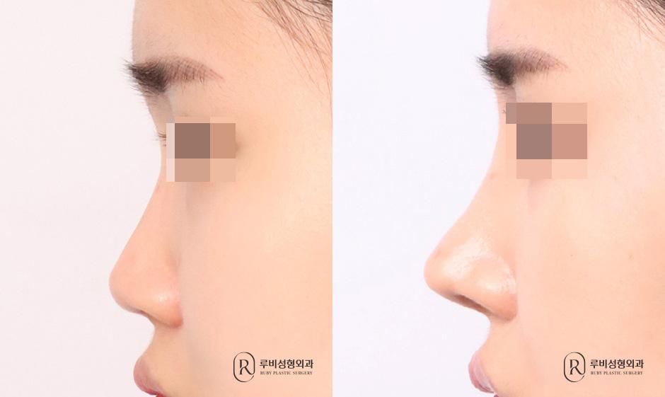 Nasal bridge, nasal tip, short nose correction