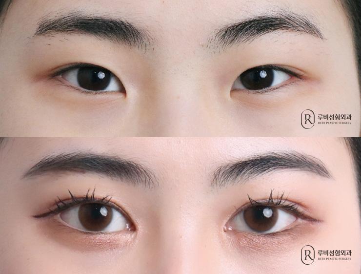 Natural adhesion, ptosis correction, medial, lateral and lower canthoplasty