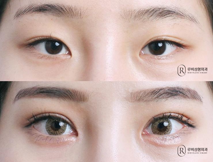 Natural adhesion, ptosis correction, medial and lateral canthoplasty