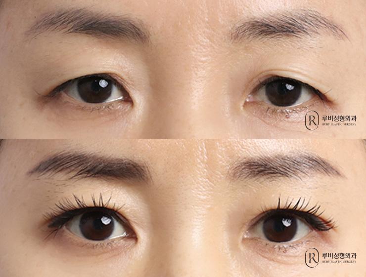 Natural adhesion, ptosis correction