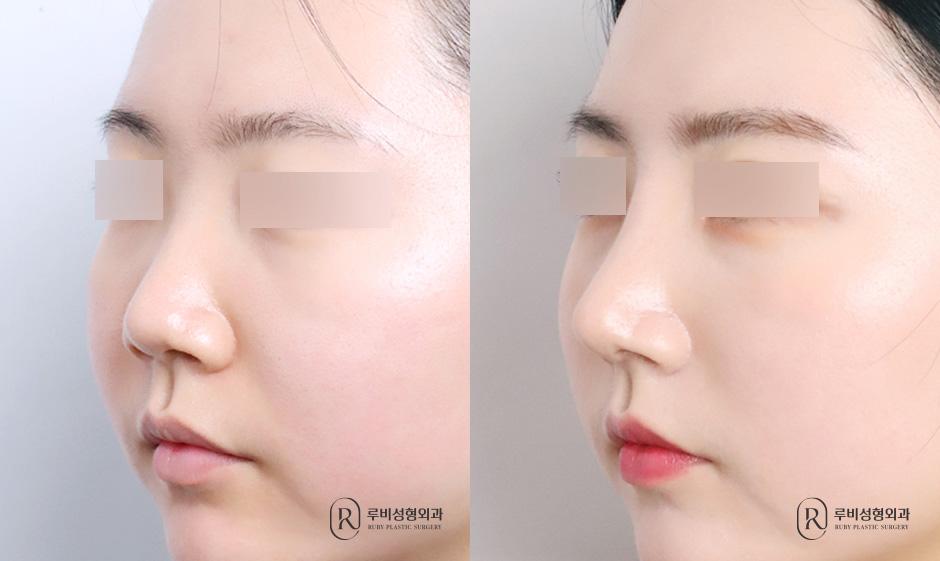 Nose bridge, nose tip, humpectomy, short nose correction