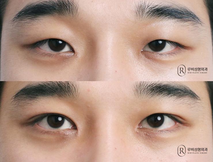 Men's natural adhesion, ptosis correction, epicanthoplasty
