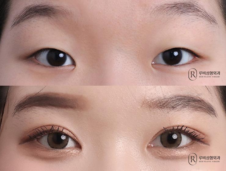 Natural adhesion, ptosis correction, epicanthoplasty
