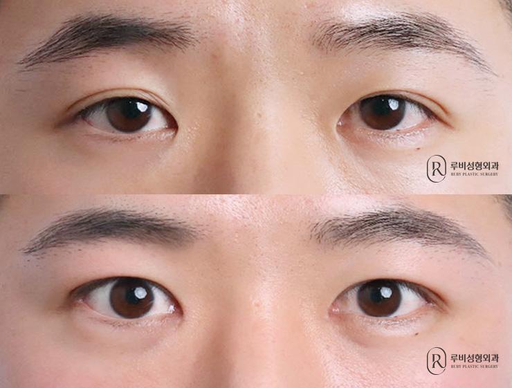 Men's natural adhesion, ptosis correction, medial and lateral canthoplasty
