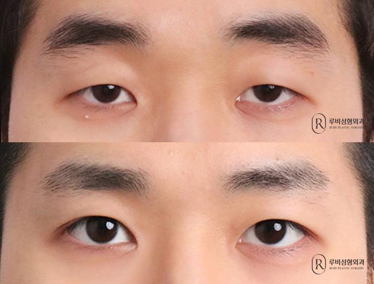 Men's natural adhesion, ptosis correction, lateral canthoplasty