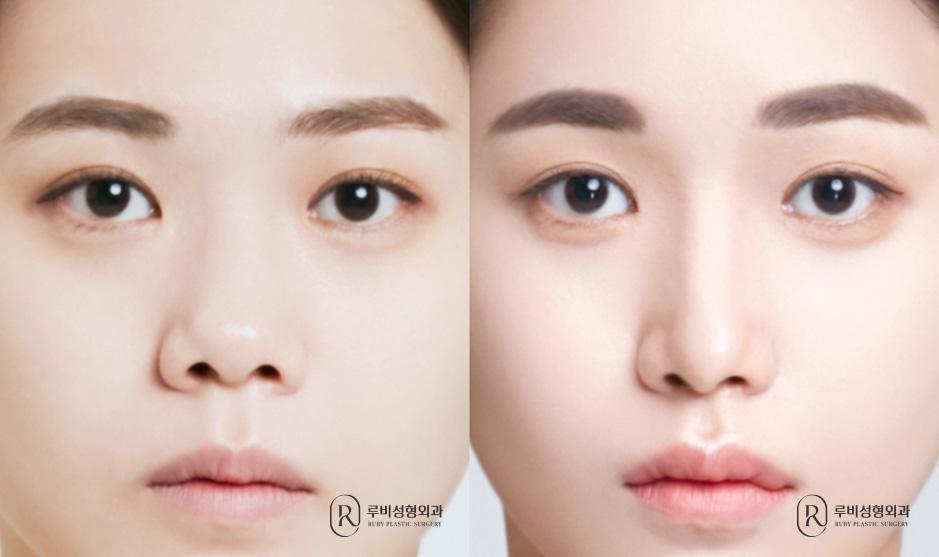 코성형