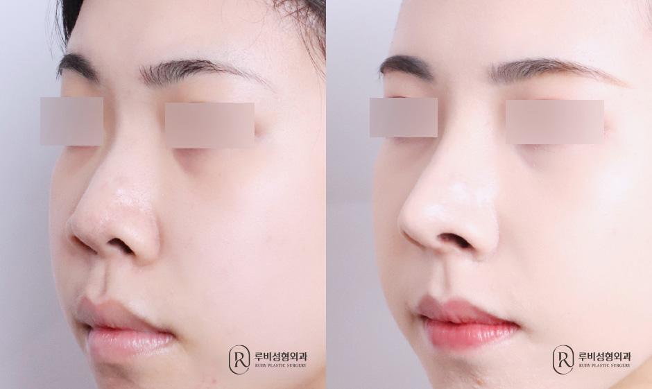 Nasal bridge, nasal tip, short nose correction, alar cinching