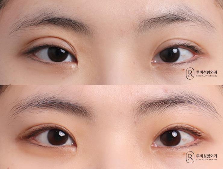 Incisional, ptosis correction, revision surgery
