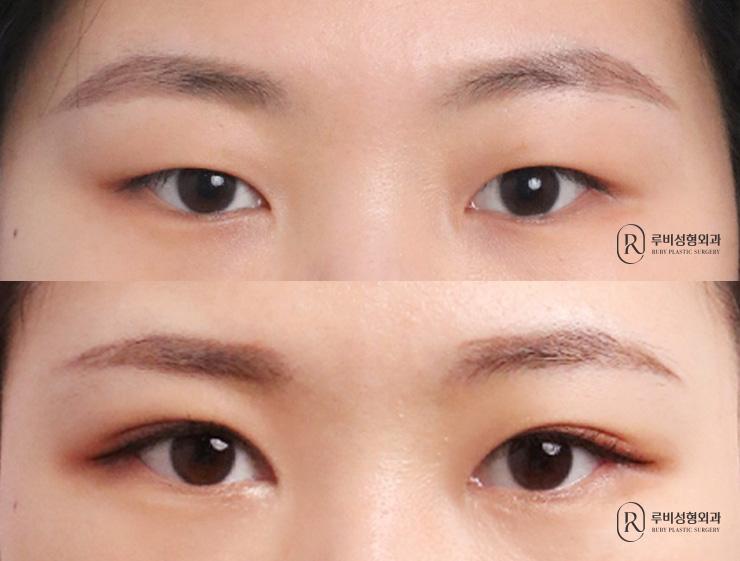 Natural adhesion, ptosis correction, medial and lateral canthoplasty