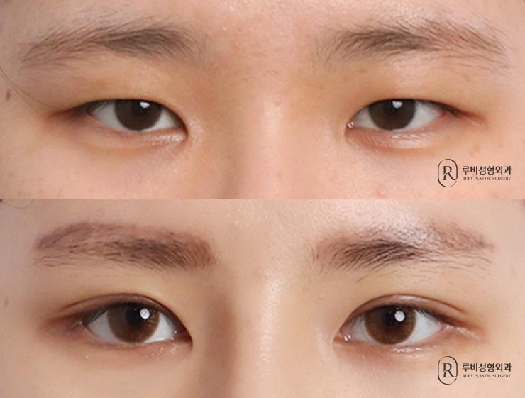Natural adhesion, ptosis correction, medial, lateral and lower canthoplasty