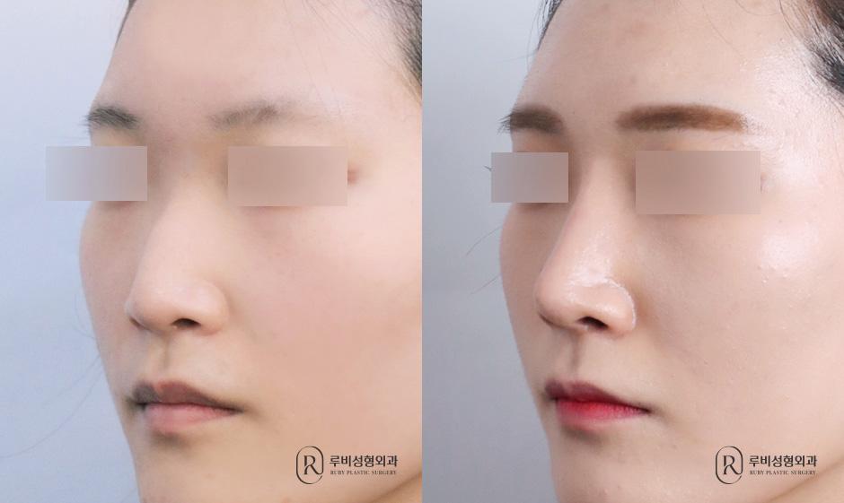 Nose bridge, nose tip, humpectomy, long nose correction