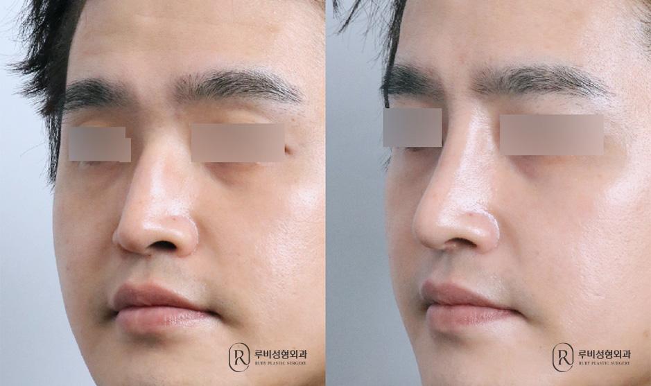 Nose bridge, nose tip, humpectomy, long nose correction