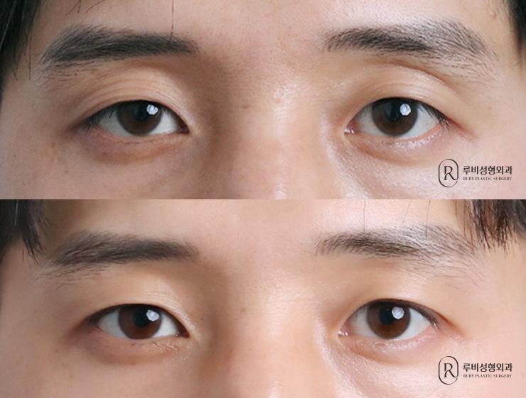 Men's natural adhesion, ptosis correction