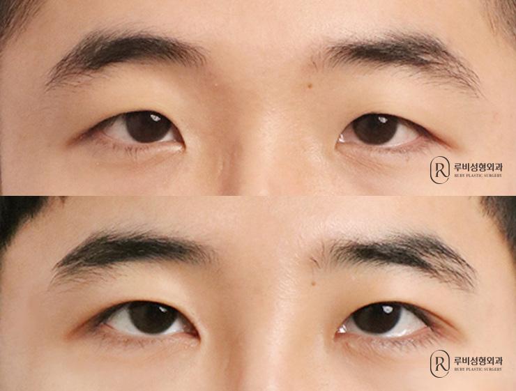 Men's natural adhesion, ptosis correction, medial and lateral canthoplasty