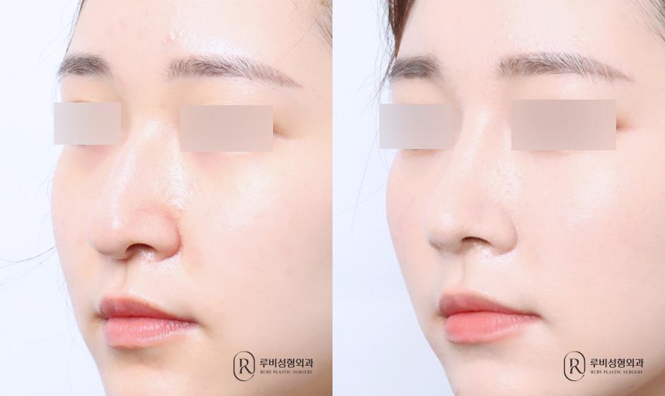 Nose bridge, nose tip, humpectomy, long nose correction