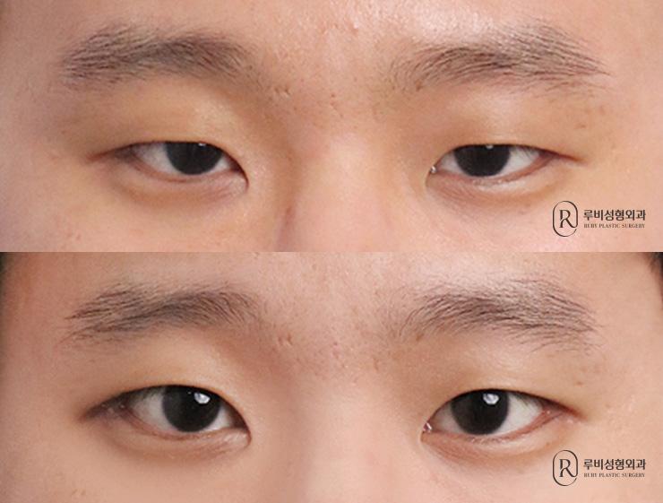 Men's natural adhesion, ptosis correction, lateral canthoplasty