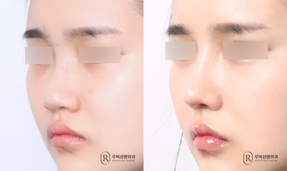 Nasal bridge, nasal tip, short nose correction, donor cartilage