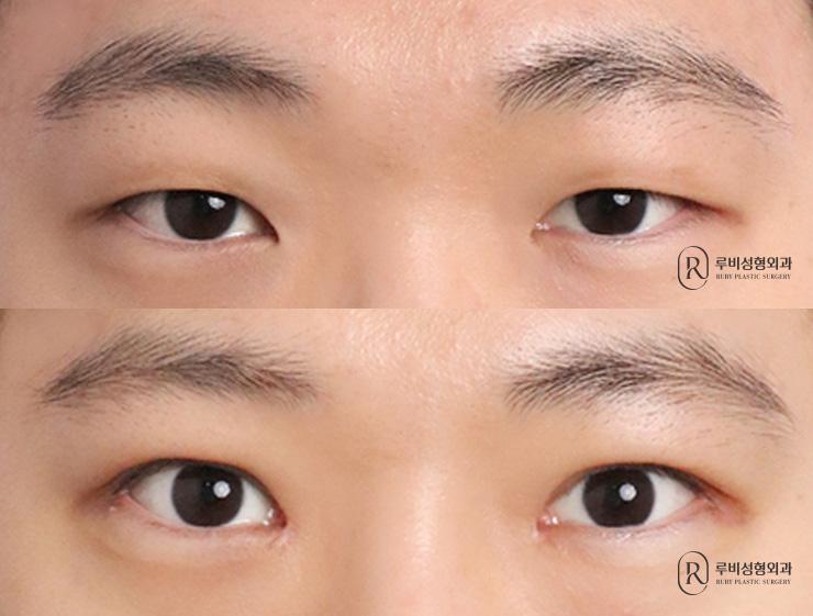 Men's natural adhesion, ptosis correction, medial and lateral canthoplasty, fat removal