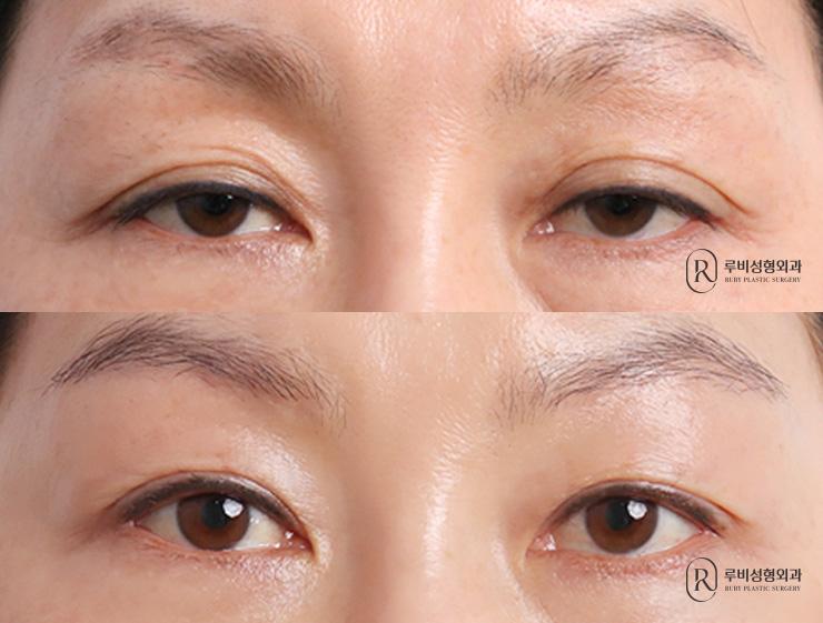 Brow lift, natural adhesion, ptosis correction