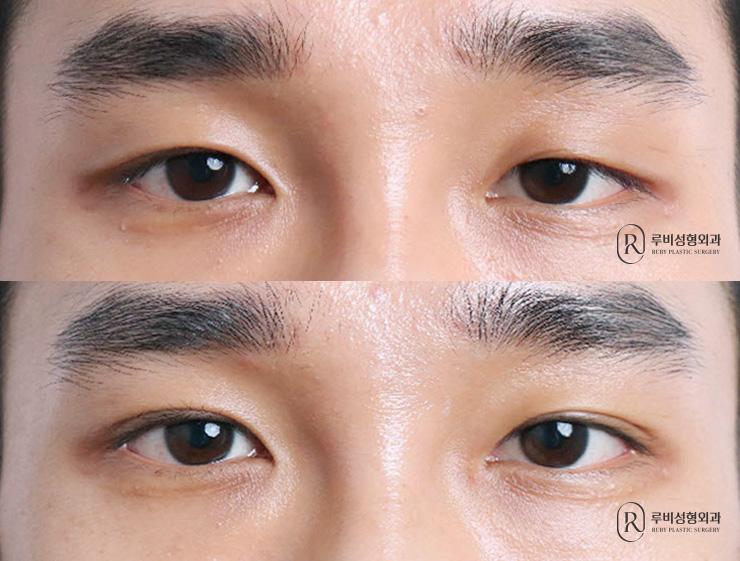 Men's natural adhesion, ptosis correction