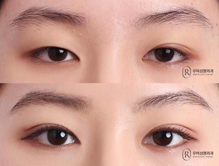 Natural adhesion, ptosis correction