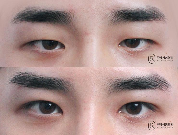 Men's natural adhesion, ptosis correction, medial and lower canthoplasty