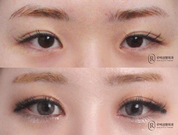 Medial and lateral canthoplasty