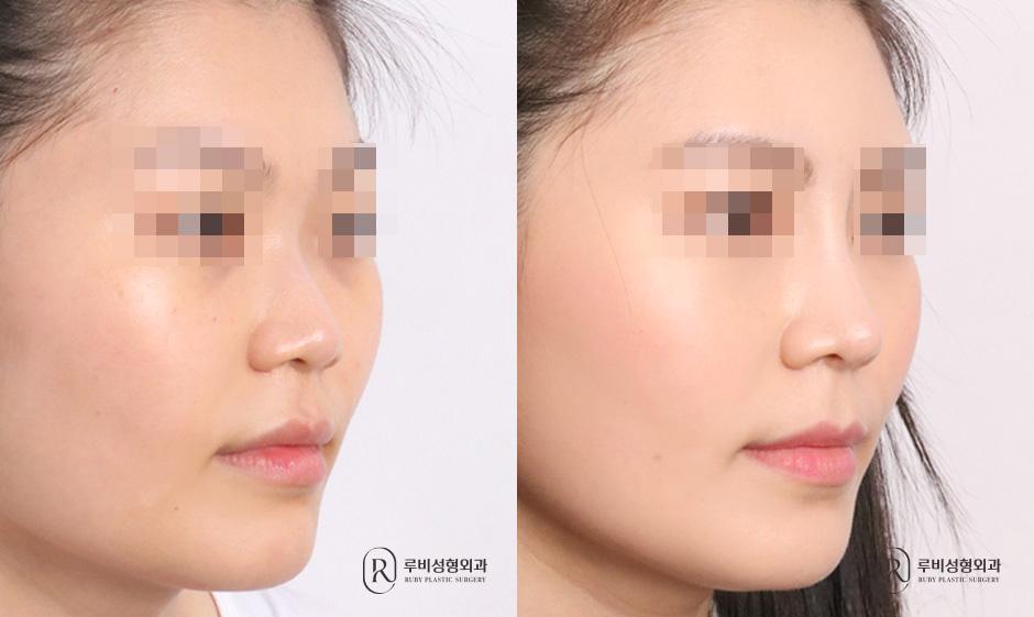 Nasal bridge, nasal tip, short nose correction