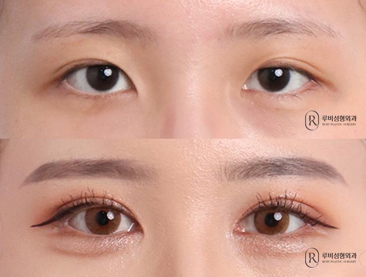 Natural adhesion, ptosis correction, epicanthoplasty