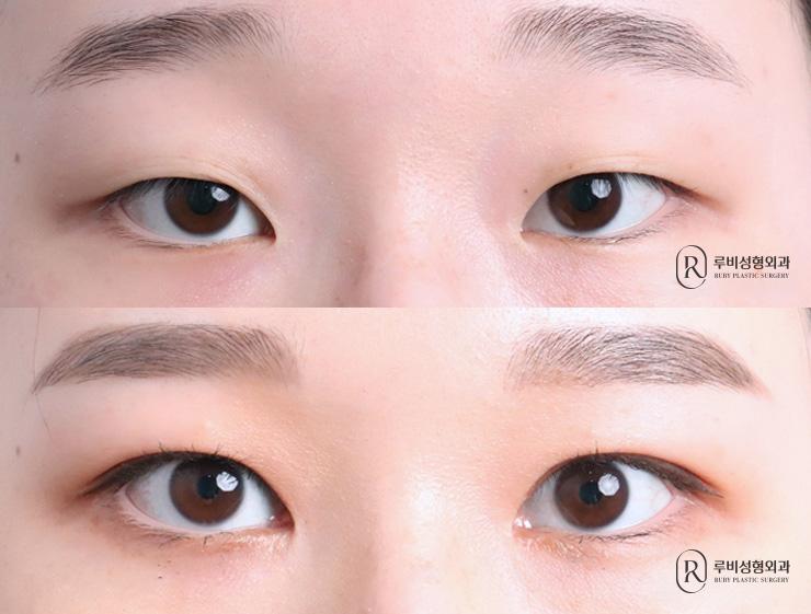 Natural adhesion, ptosis correction, epicanthoplasty