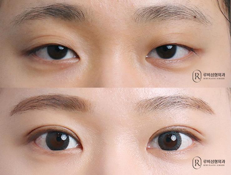 Natural adhesion, ptosis correction, epicanthoplasty