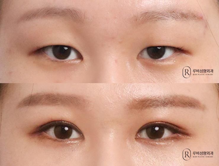 Natural adhesion, ptosis correction, lateral canthoplasty