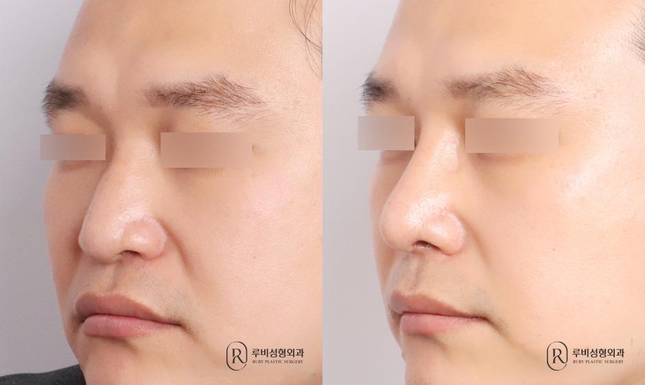Nose bridge, nose tip, humpectomy, bulbous nose correction, alar cinching