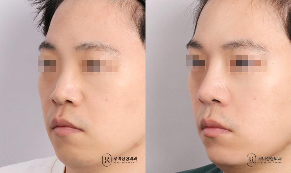 Nose bridge, nose tip, bulbous nose correction, humpectomy, alar cinching