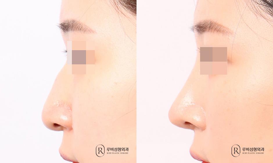 Nose bridge, nose tip, humpectomy, long nose correction