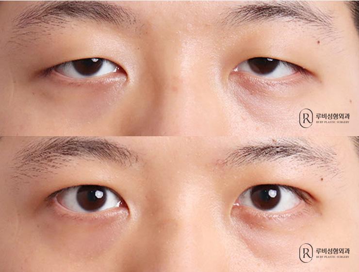 Men's natural adhesion, ptosis correction