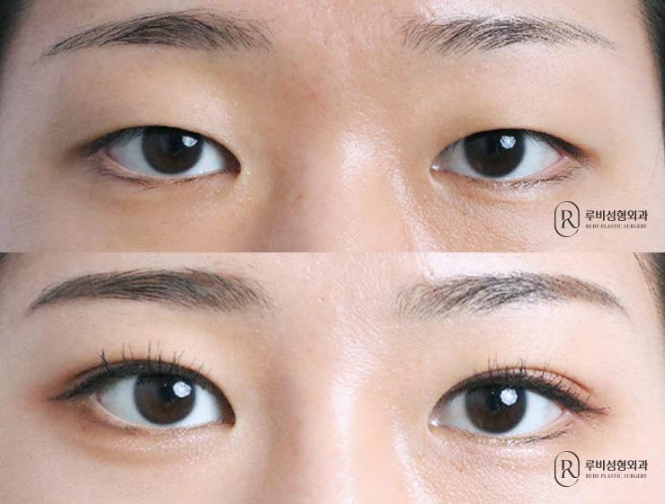 Natural adhesion, ptosis correction